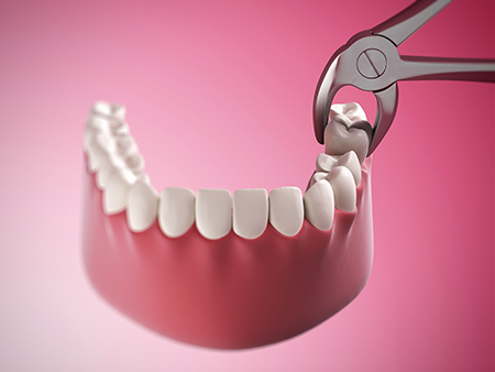 The image shows a close-up view of a dental implant being placed into a tooth socket using a pair of precision pliers.